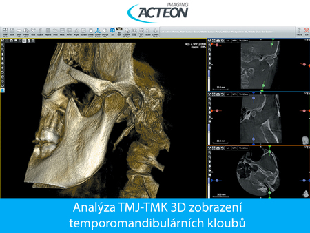 CBCT 3D analýza TMJ-TMK