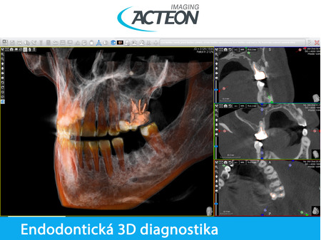 CBCT 3D endodontická diagnostika1