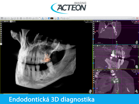 CBCT 3D endodontická diagnostika2