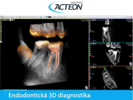 CBCT 3D endodontická diagnostika3