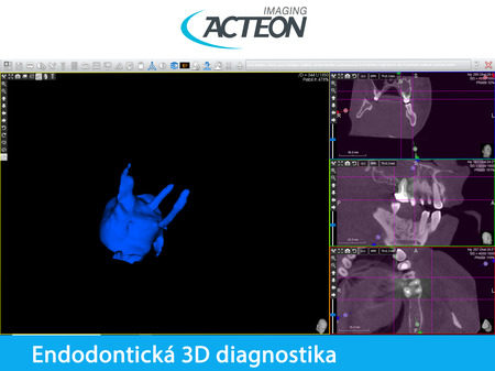 CBCT 3D endodontická diagnostika4