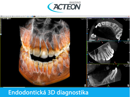 CBCT 3D endodontická diagnostika6