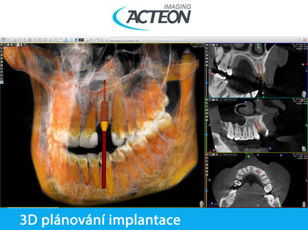 CBCT 3D implantologické plánování