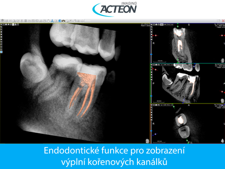 CBCT 3D endodontické zobrazení kořenových výplní