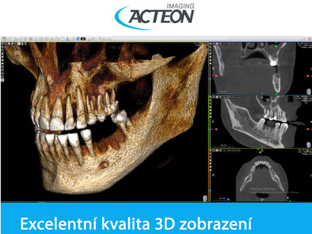 CBCT 3D kvalita zobrazení