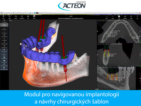 CBCT 3D modul pro návrhy chirurgických šablon