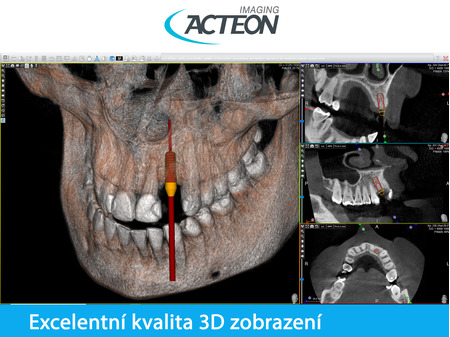 CBCT 3D plánování implantátů2