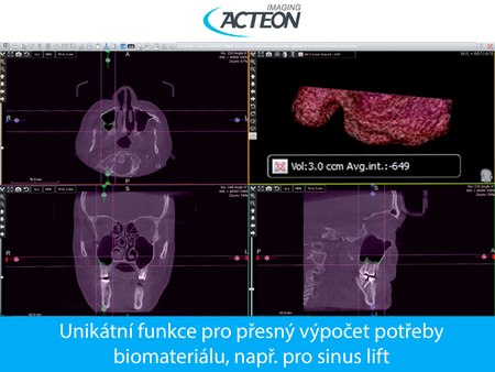 CBCT 3D přesný výpočet potřeby biomateriálu