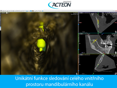 CBCT 3D unikatní funkce sledování prostoru mandibulárního kanálu