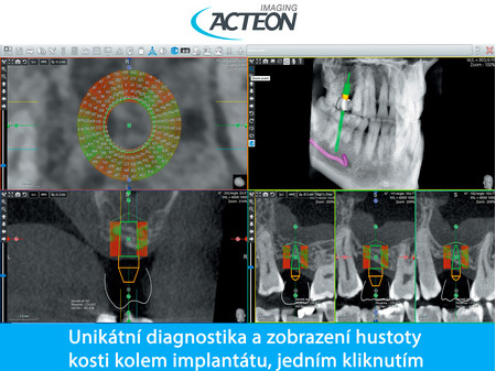 CBCT 3D unikatní zobrazení hustoty kosti