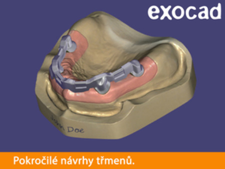 Exocad Bar module