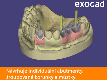 Exocad Implant module