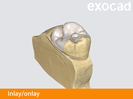 Exocad Inlay/onlay