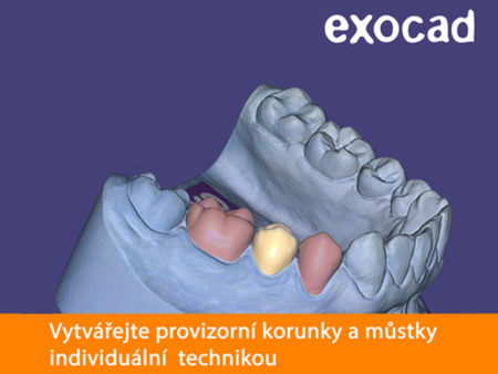 Exocad Provisional Module