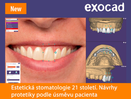 Exocad Smile Creator