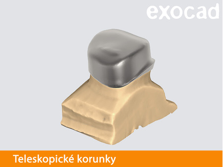 Exocad teleskopické korunky