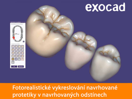 Exocad TruSmile Technology