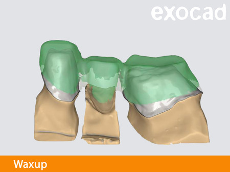 Exocad waxup