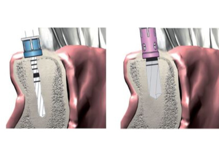 MEISINGER Implant Preparation Kit with Stop