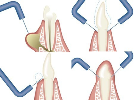 Nástroj I22CA Incision Ø 0.22mm