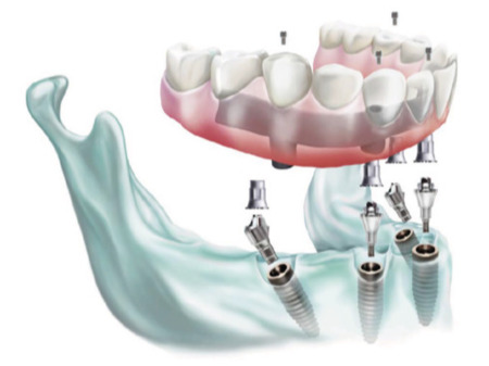 OKTAGON® Multi-Unit abutmenty