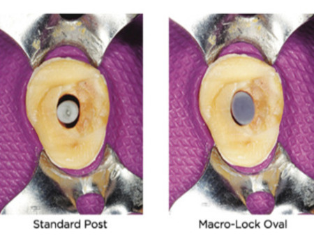 Macrolock OvalPost 1, (5ks/bal)