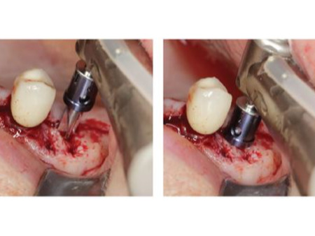 MEISINGER Periimplantitis Kit