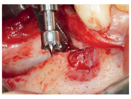 MEISINGER Trephine Ejection Kit by. Prof. Dr. Khoury, BTE00