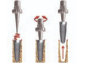Nástroje na extrakci implantátu a odstranění šroubku 